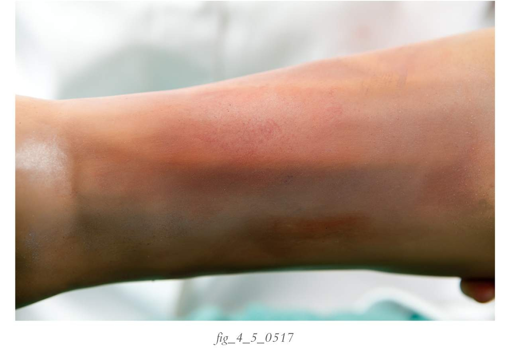 Wound of the Month Fresh Bruise or Contusion