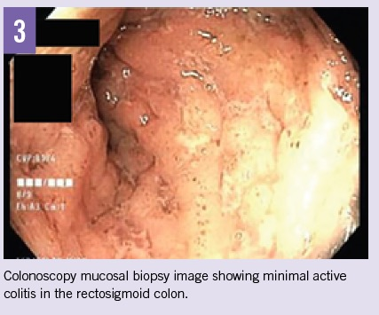 cd biopsy 3