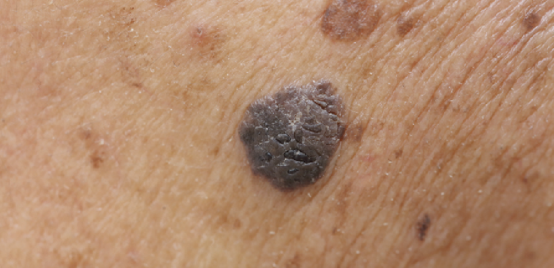 mole suspicious of melanoma