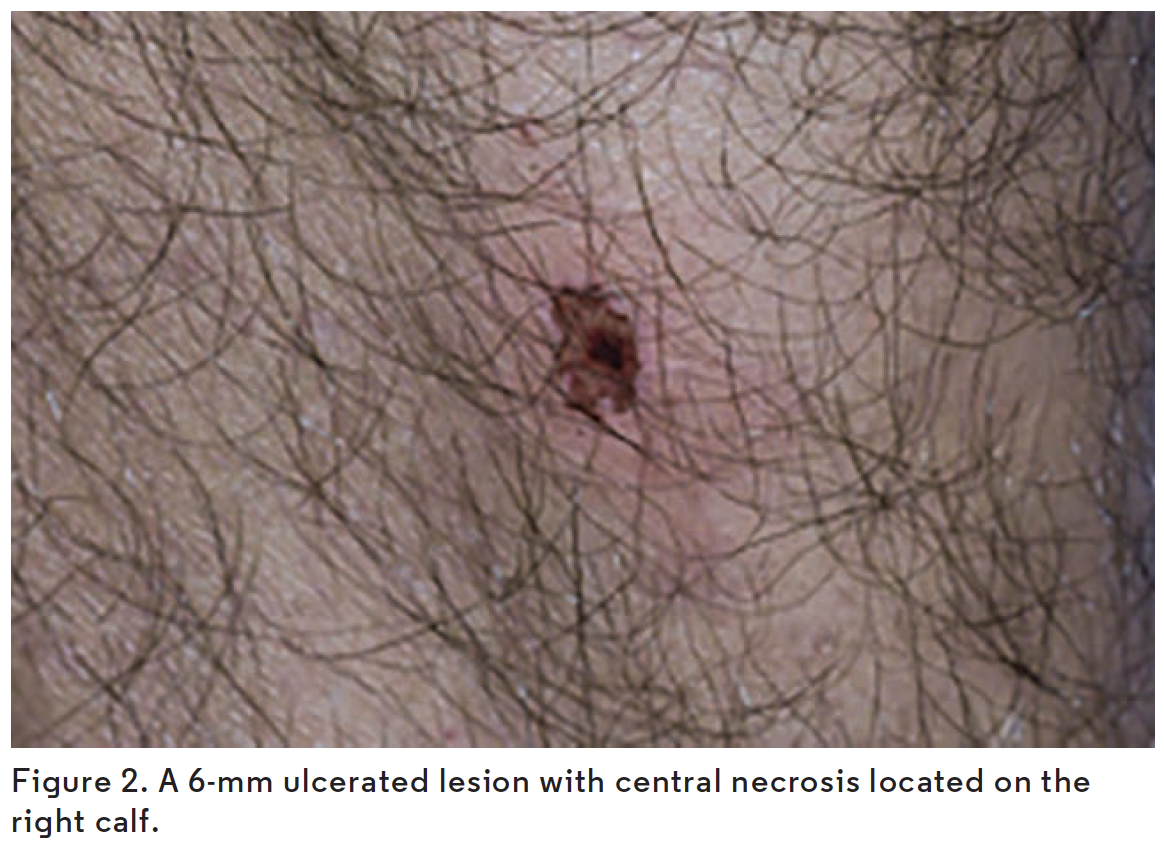 6-mm ulcerated lesion with central necrosis located on the right calf.