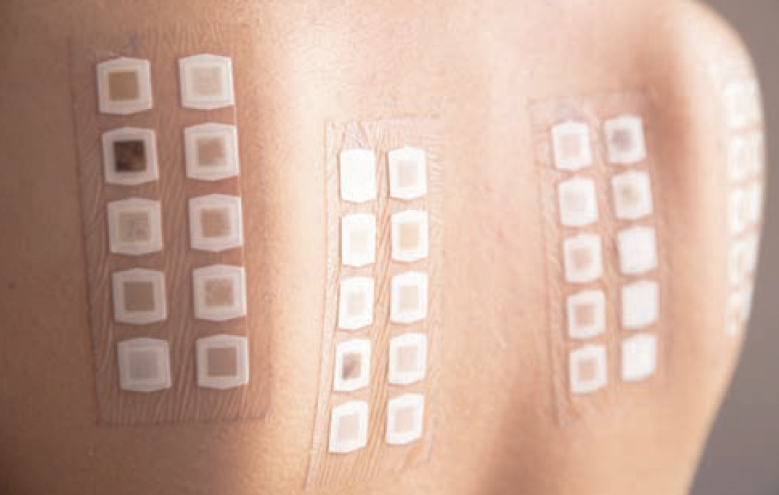 patch testing