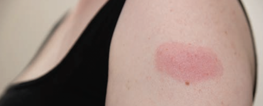 cutaneous vax reaction