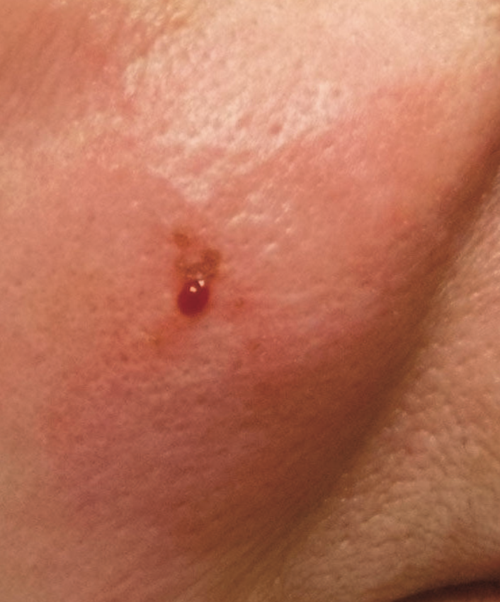 P Acnes