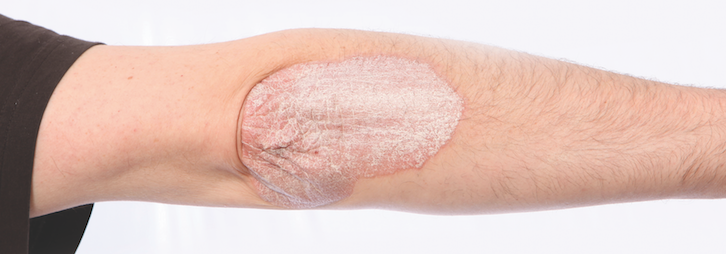 psoriasis on elbow