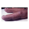 Figure 2. Primary inoculation of sporotrichosis. Source: Graham Library of Digital Images, Wake Forest University Department of Dermatology © 2009 Wake Forest University Dermatology
