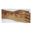 Figure 3. Sporotrichosis with lymphatic spread. Source: Graham Library of Digital Images, Wake Forest University Department of Dermatology © 2009 Wake Forest University Dermatology
