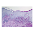 Figure 4. Sporotrichosis. Hyperplasia of the epidermis with microabscess formation and granulomatous infiltrate of superficial dermis. (DPAS x 10) Source: Graham Library of Digital Images, Wake Forest University Department of Dermatology © 2009 Wake Forest University Dermatology
