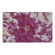 Figure 6. Asteroid body with spore in its center. (PAS-PA x 250) Source: Graham Library of Digital Images, Wake Forest University Department of Dermatology © 2009 Wake Forest University Dermatology