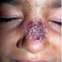 Leishmaniasis