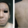 Leprosy