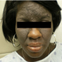 Contact Dermatitis