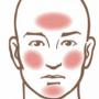 Figure 4: Contact dermatitis due to makeup and moisturizer Contact Dermatitis
