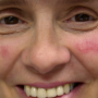 Contact Dermatitis
