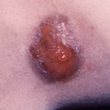 fungal