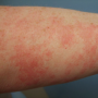 Derm DX