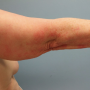 Derm DX