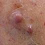 Derm DX
