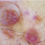 Derm DX