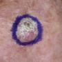 High-risk NMSC