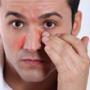 Seborrheic dermatitis