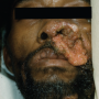 Figure 1. Secondary cutaneous lesion in disseminated coccidioidomycosis presenting as a verrucous plaque on the nasolabial fold. Source: Graham Library of Digital Images, Wake Forest University Department of Dermatology © 2009 Wake Forest University Dermatology