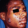Figure 2. Secondary cutaneous coccidioidomycosis presenting as multiple papules on the face and neck. Source: Graham Library of Digital Images, Wake Forest University Department of Dermatology © 2009 Wake Forest University Dermatology