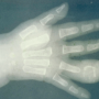 Figure 3. Bone involvement of the right 4th finger in a young child with disseminated coccidioidomycosis. Source: Graham Library of Digital Images, Wake Forest University Department of Dermatology © 2009 Wake Forest University Dermatology