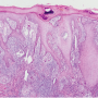 Figure 4. Histology showing pseudoepitheliomatous hyperplasia and a diffuse granulomatous dermal infiltrate in a lesion of cutaneous coccidioidomycosis. Source: Graham Library of Digital Images, Wake Forest University Department of Dermatology © 2009 Wake Forest University Dermatology