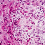 Figure 5. Coccidioidomycosis. Routine H&E stain reveals a large spherule in a background of granulomatous inflammation. Source: Graham Library of Digital Images, Wake Forest University Department of Dermatology © 2009 Wake Forest University Dermatology