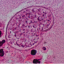 Figure 6. A large thick-walled coccidioidomycosis spherule containing numerous endospores. Source: Graham Library of Digital Images, Wake Forest University Department of Dermatology © 2009 Wake Forest University Dermatology