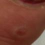 Derm DX