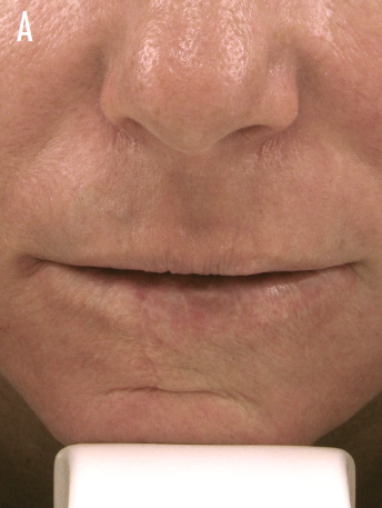 lips before