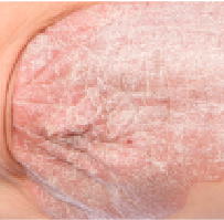psoriasis