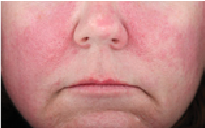 brimonidine