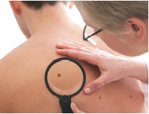 melanoma