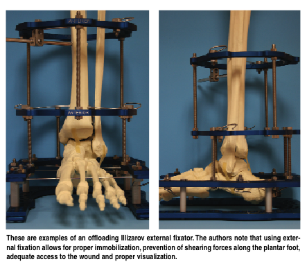 Current Concepts In Surgical Offloading Of DFUs