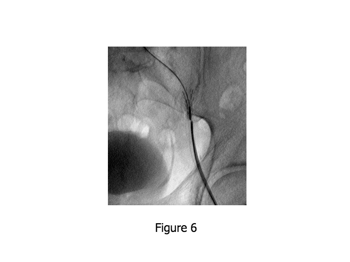 Early Systemic Device Embolization after Transcatheter Patent Foramen Ovale Closure