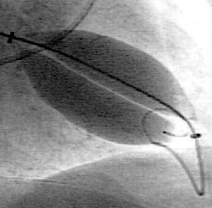 Mitral Stenosis and Percutaneous Mitral Valvuloplasty (Part 1