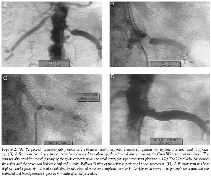 Guardwire Protected Renal Stenting With the PercuSurge GuardWire Device: A Pilot ...