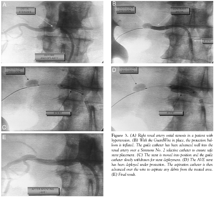 Guardwire Protected Renal Stenting With the PercuSurge GuardWire Device: A Pilot ...