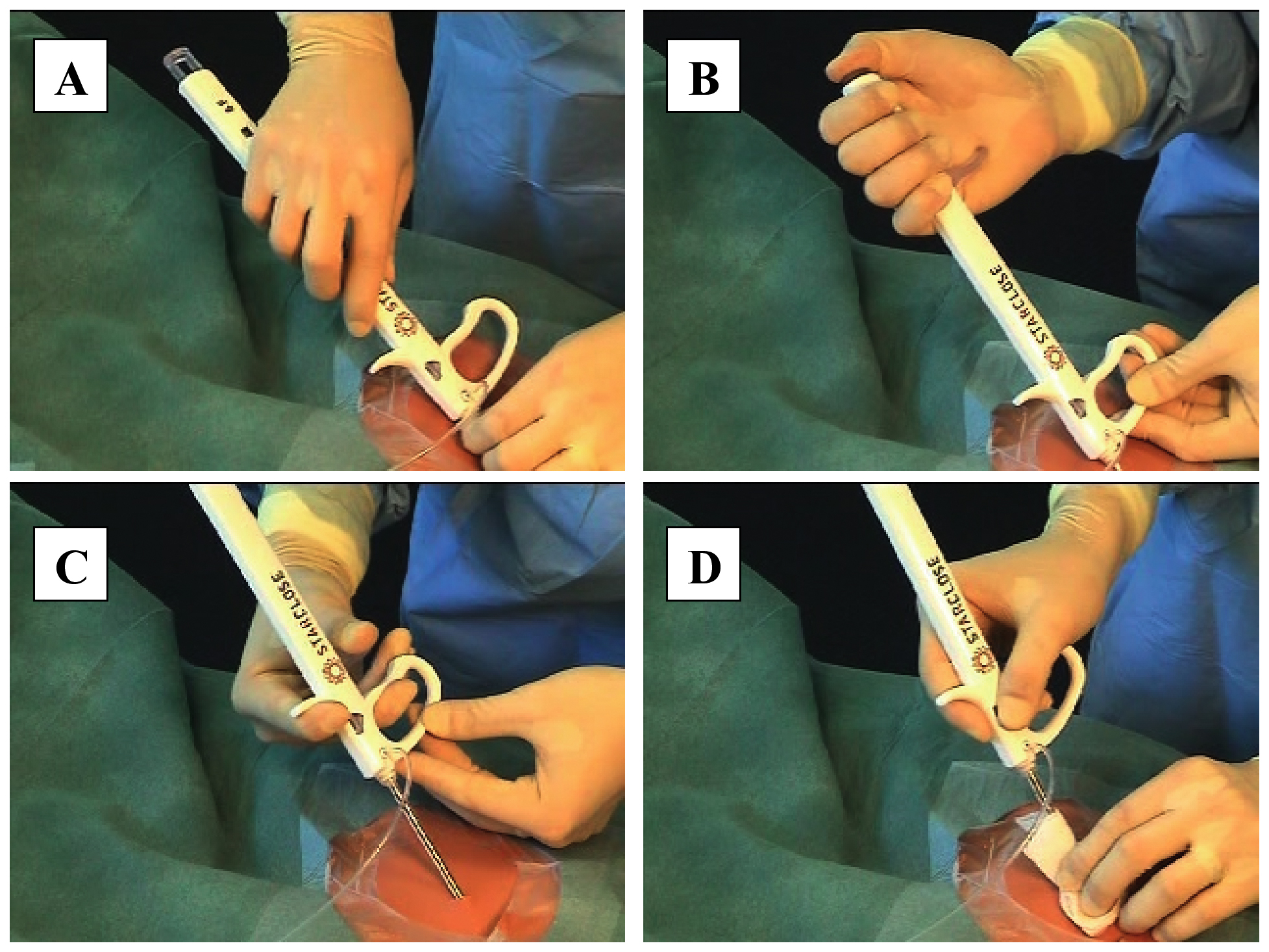 Clinical Experience with a Circumferential ClipBased Vascular Closure