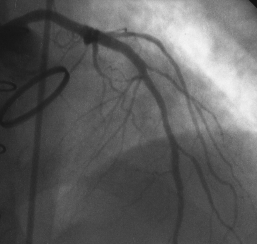 Unrecognized Stent Embolization Causing Recurrent Chest Pain