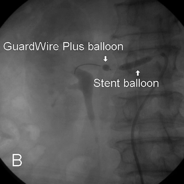 Guardwire Renal Angioplasty Under Protection of the PercuSurge GuardWire Plus System