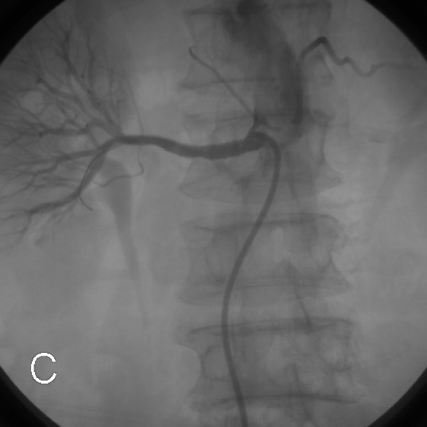 Guardwire Renal Angioplasty Under Protection of the PercuSurge GuardWire Plus System