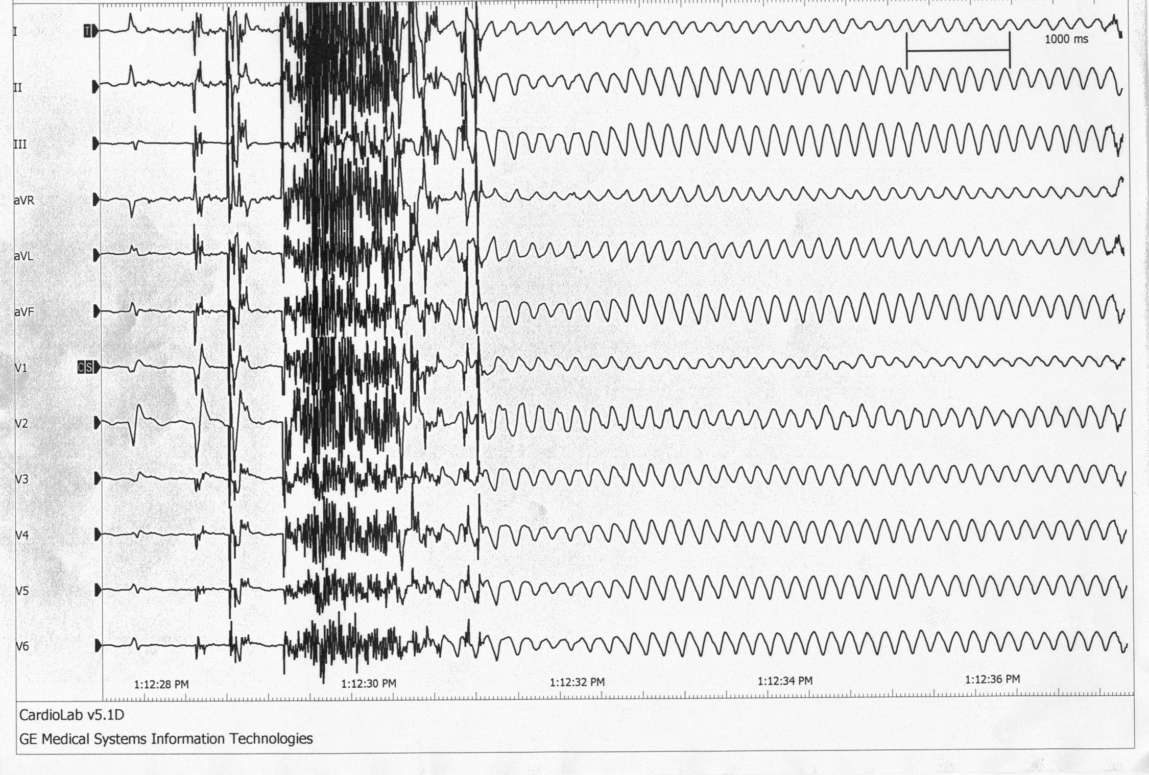 ElectrocauteryInduced Ventricular Tachycardia and Fibrillation during