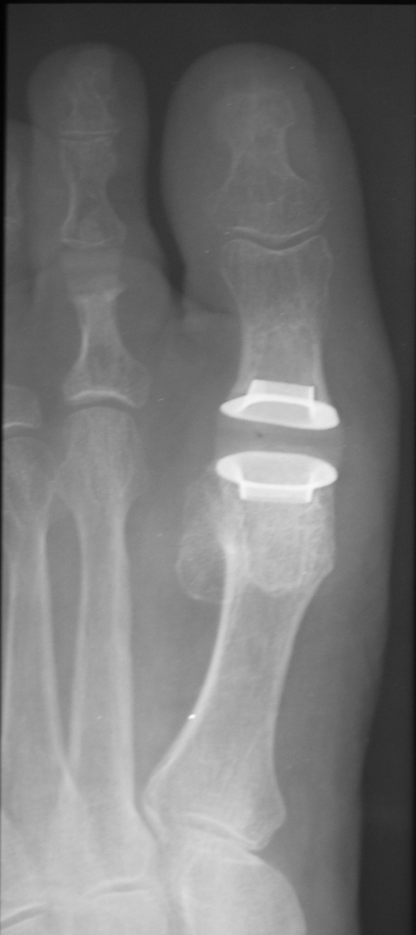 A Closer Look At The Primus First MPJ Implant