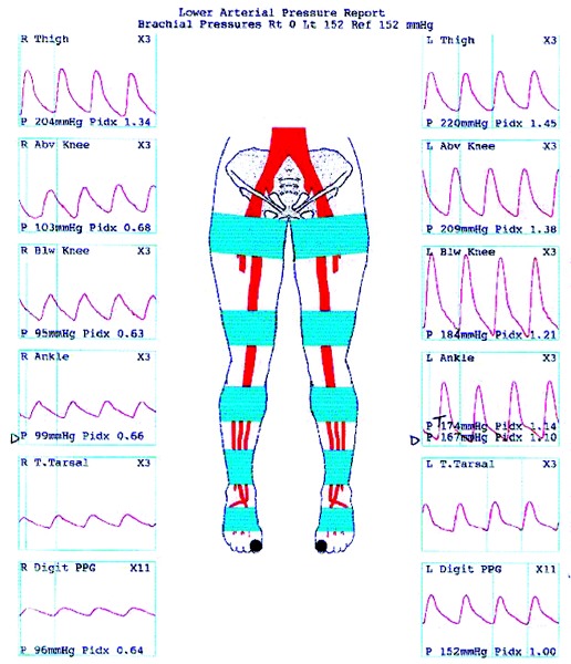How To Detect Peripheral Arterial Disease