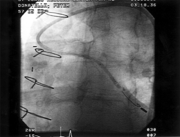 Guardwire Percusurge Guardwire Balloon-Associated Thrombus — A Limitation of ...