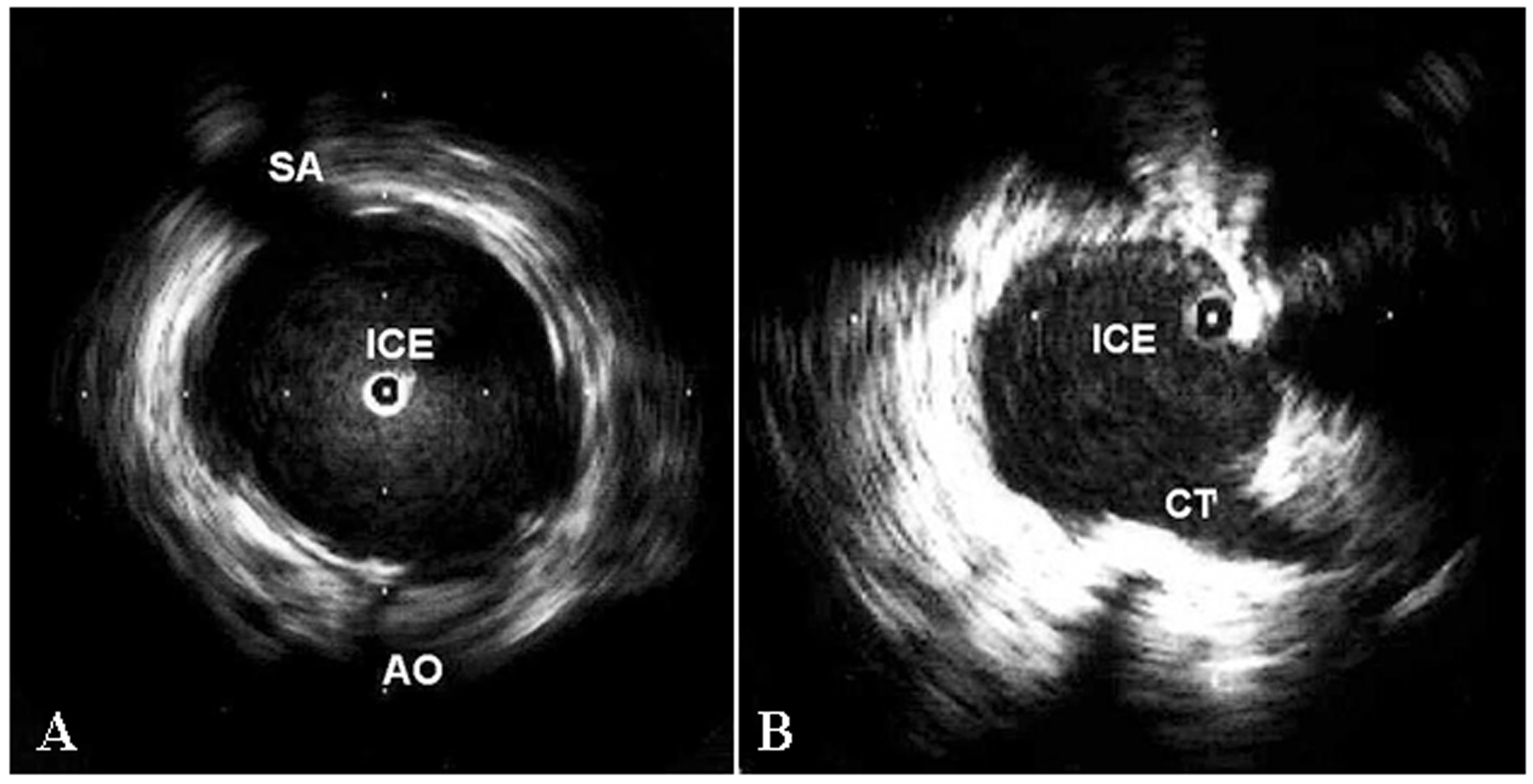 Intracardiac Echocardiography in Cardiovascular CatheterBased