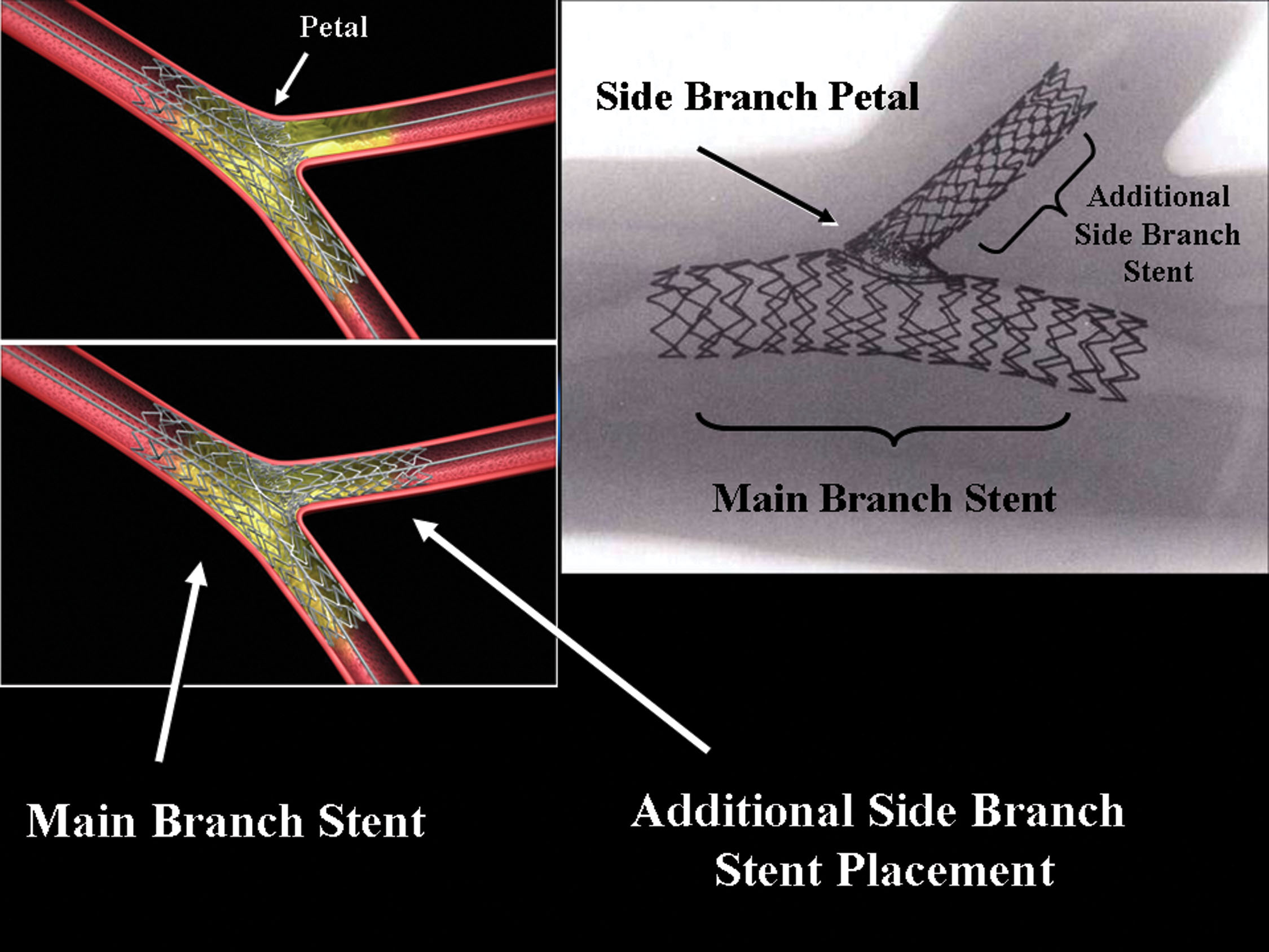 Bifurcation Coronary Artery Disease Current Techniques and Future